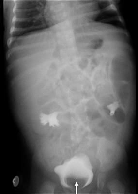 Treatment for complete bilateral duplex kidneys with severe hydronephrosis and ureterectasis of the upper moiety in a child: A case report and literature review